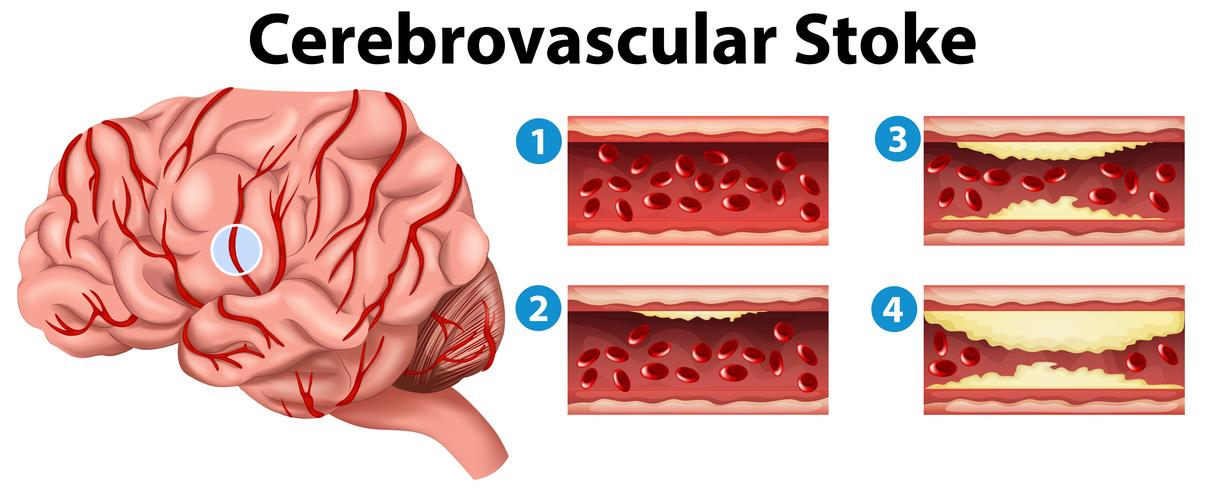 Diagram showing stages of cerebrovascular stroke vector