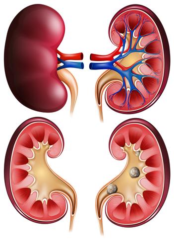 Kidneys and kidney stones on poster vector