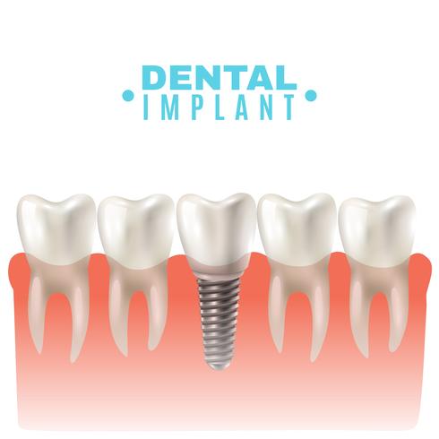 Dental Implant Model Side View Poster  vector