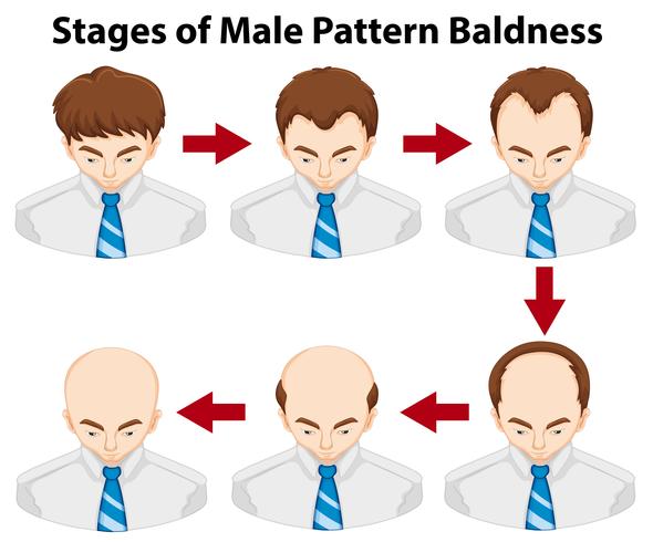 Diagram showing stages of male pattern baldness vector