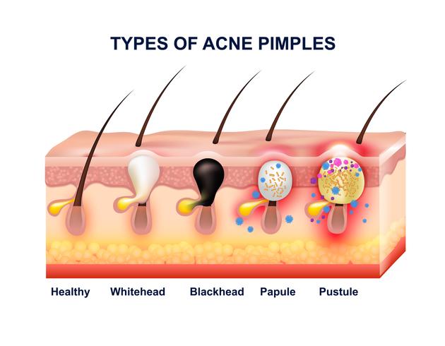 Composición de la anatomía del acné de la piel vector