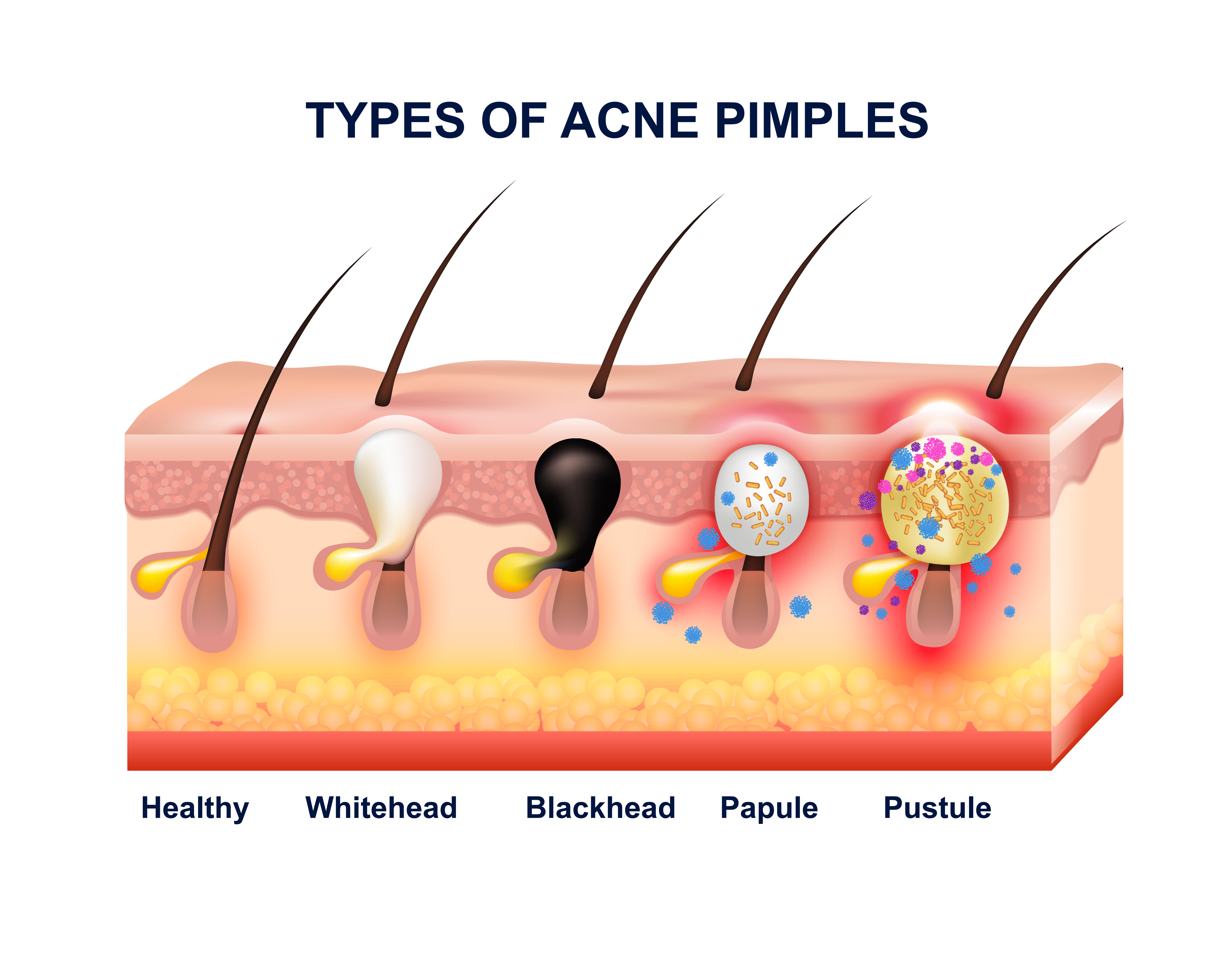 Skin Acne Types Diagram Vector Skin Problems Disease Pimples | The Best ...