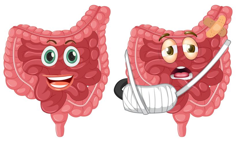 Conjunto de intestino sano y lesionado. vector