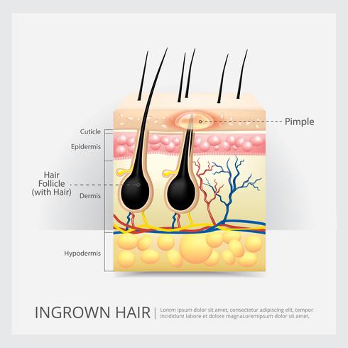 Ingrown Hair Structure Vector Illustration