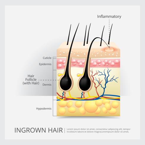 Ingrown Hair Structure Vector Illustration