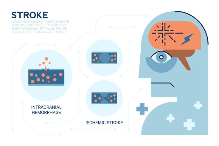 Enfermedad cerebral por accidente cerebrovascular vector