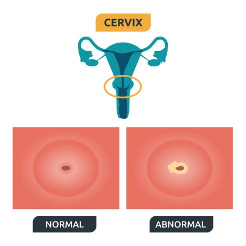 Cervix vector