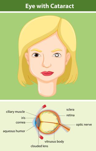 Diagram showing eye with cataract vector