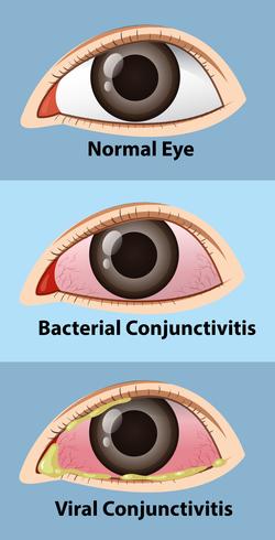 Different stages of conjunctivitis in human eye vector