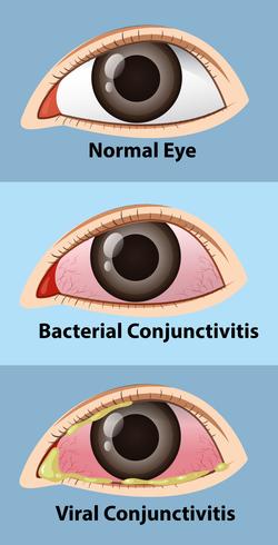 Diferentes estadios de conjuntivitis en ojo humano. vector