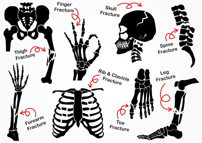 Establecer el icono de fractura ósea (pélvica, cadera, muslo (fémur), mano, muñeca, dedo, calavera, cara, vértebra, brazo, codo, tórax, pie, talón, pierna) diseño en blanco y negro (concepto de atención médica) vector