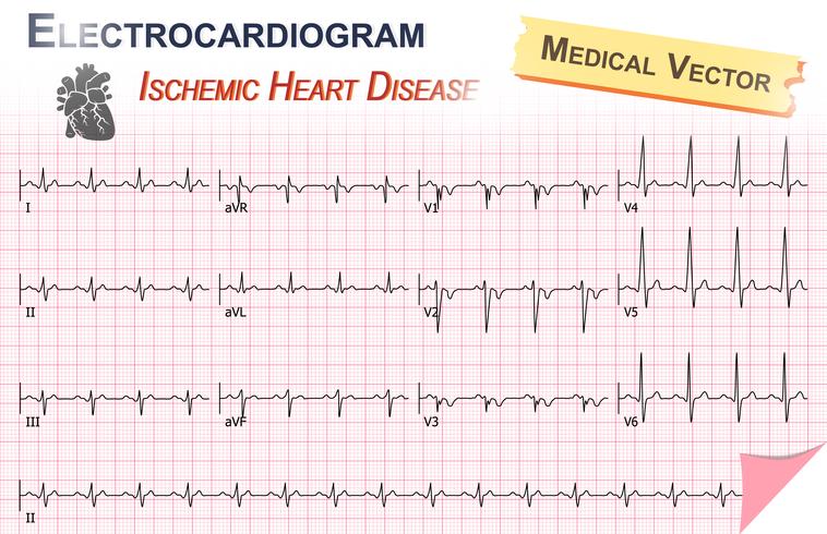 Electrocardiograma (ECG, EKG) de cardiopatía isquémica (infarto de miocardio) y anatomía del icono del corazón vector