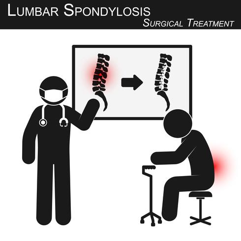 El médico explica el tratamiento quirúrgico de la espondilosis lumbar y muestra imágenes de la columna vertebral (antes y después de la operación mediante fijación interna con placa y tornillo) (vector stickman) (concepto de cuidado de la columna vertebra vector