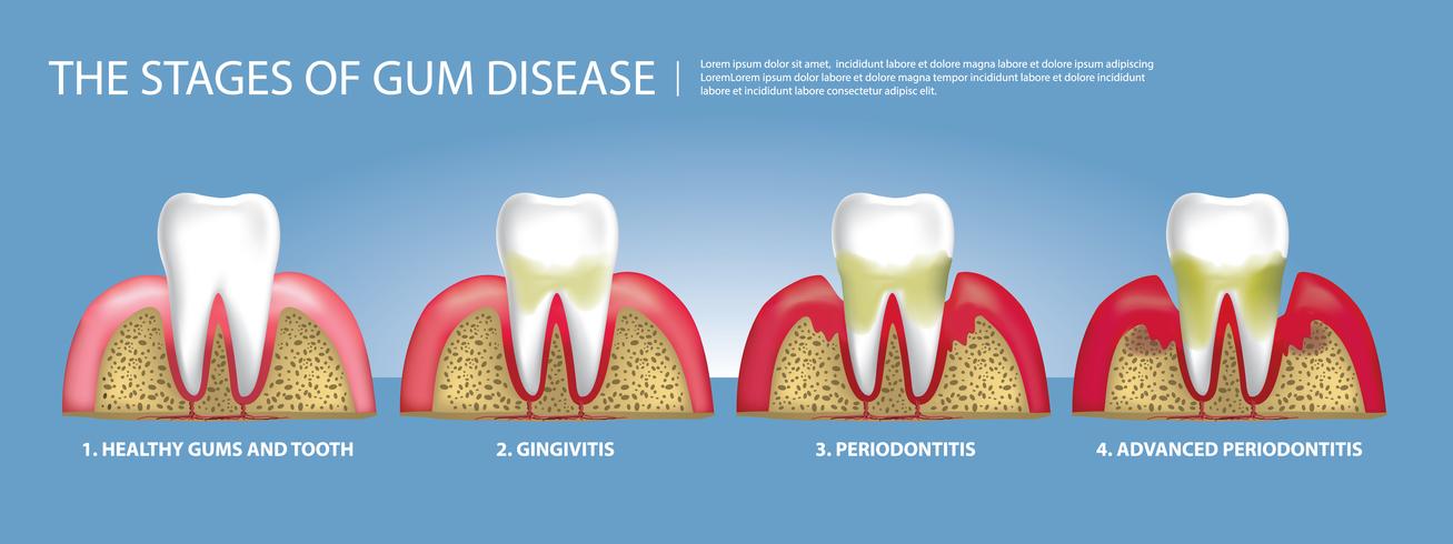 Dientes humanos etapas de la enfermedad de las encías ilustración vectorial vector