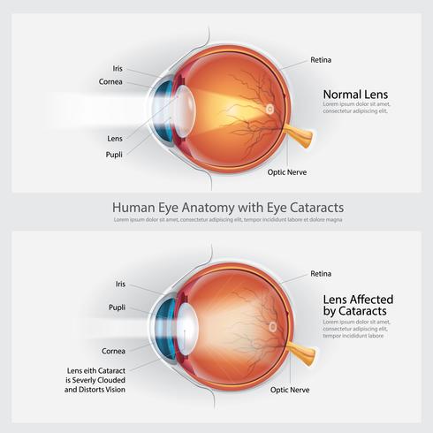 Trastorno de la visión de cataratas y anatomía ocular normal Ilustración de vector de anatomía