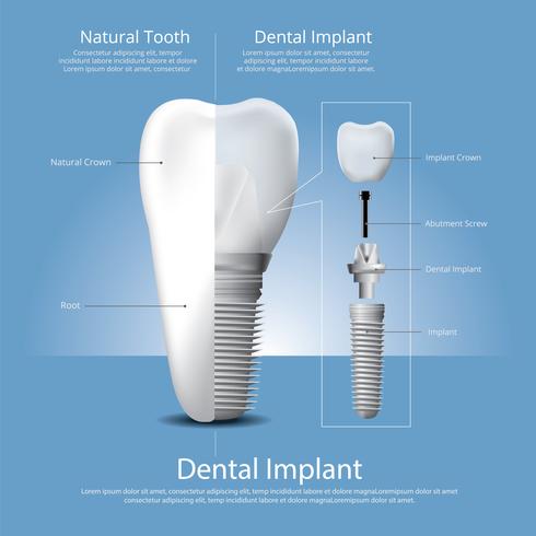 Dientes humanos e implantes dentales ilustración vectorial vector