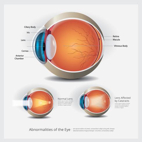 Anatomía ocular con anomalías oculares, ilustración vectorial vector