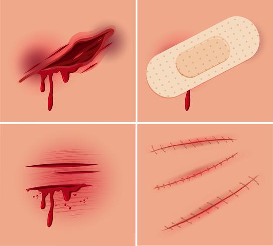 Set of fresh wound vector