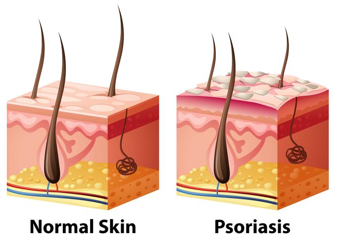 Human skin diagram with normal and psoriasis vector