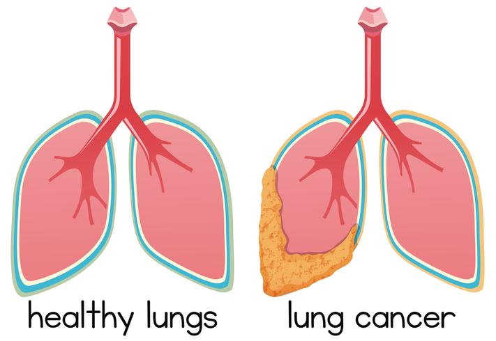 Una caricatura de la condición pulmonar vector