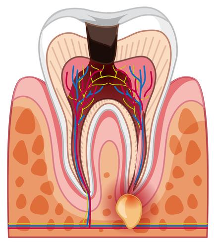 A Human Tooth Decay and Cavity vector