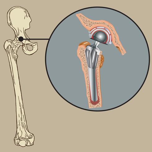 Cementless Arthroplasty Prosthesis vector