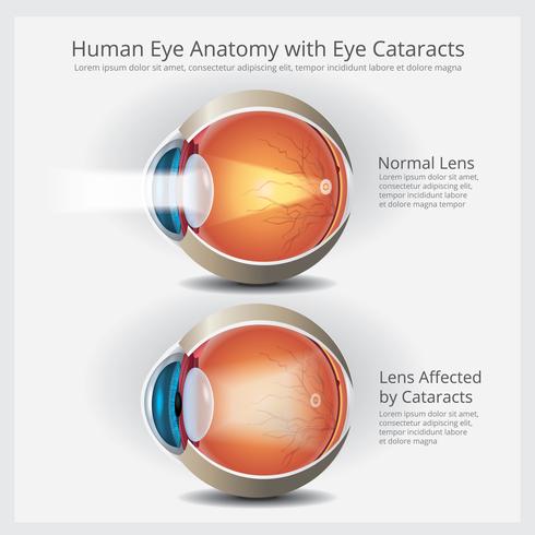 Anatomía ocular con anomalías oculares, ilustración vectorial vector