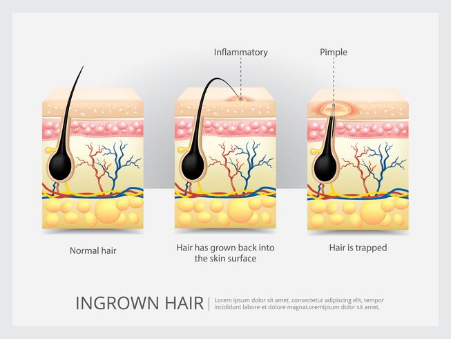 Ingrown Hair Structure Vector Illustration