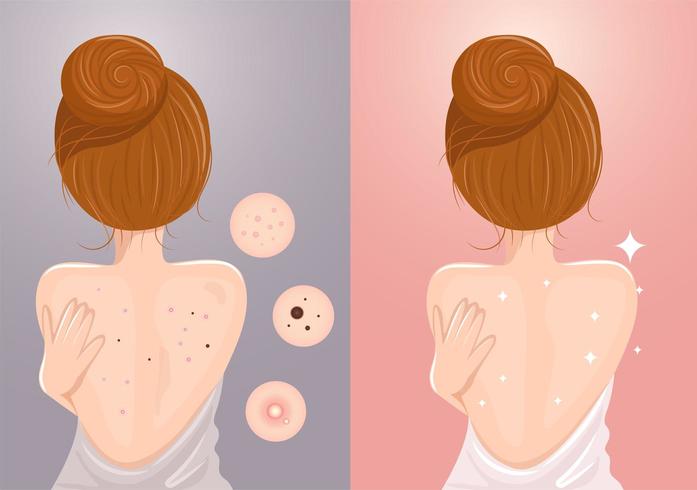 Before and after of woman with acne and without acne on her back vector