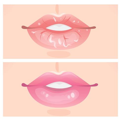 Flaky lips and beautiful lips vector