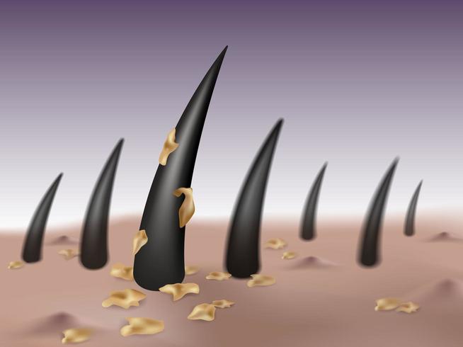 Dandruff and scalp disease concept  vector