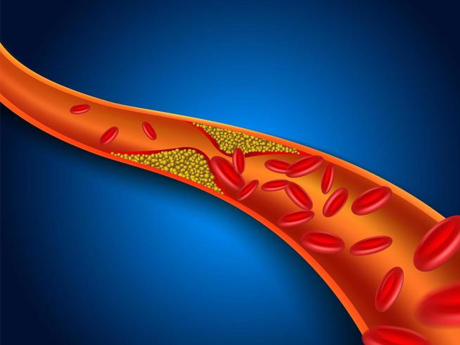 Clogged blood vessels drawing vector