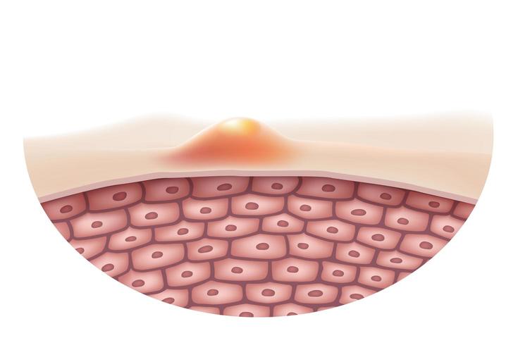 Cerca de la protuberancia del acné en la superficie de la piel vector