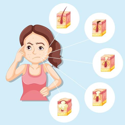 Scientific medical illustration of pimple formation vector