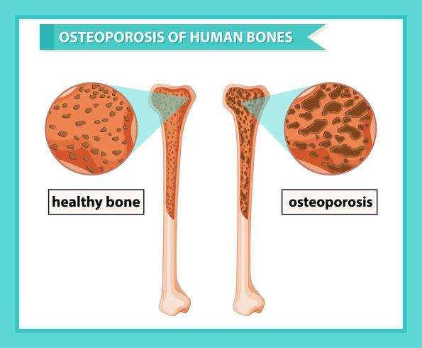 Scientific medical illustration of osteoporosis of bones