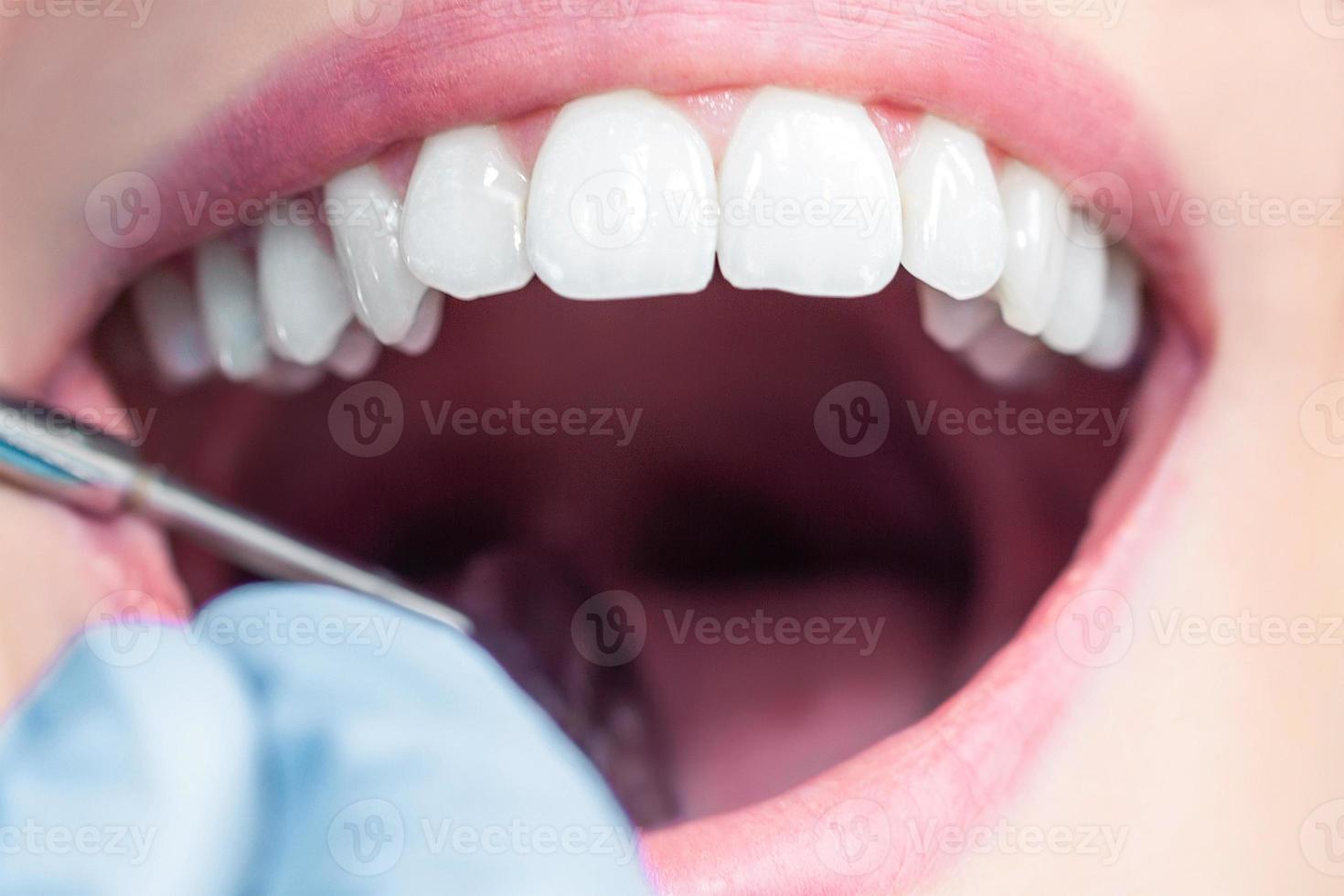 Healthy Female Teeth photo