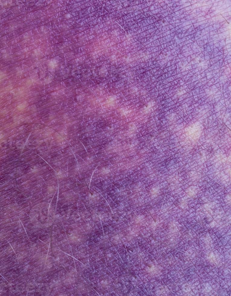 Bruise Close up photo