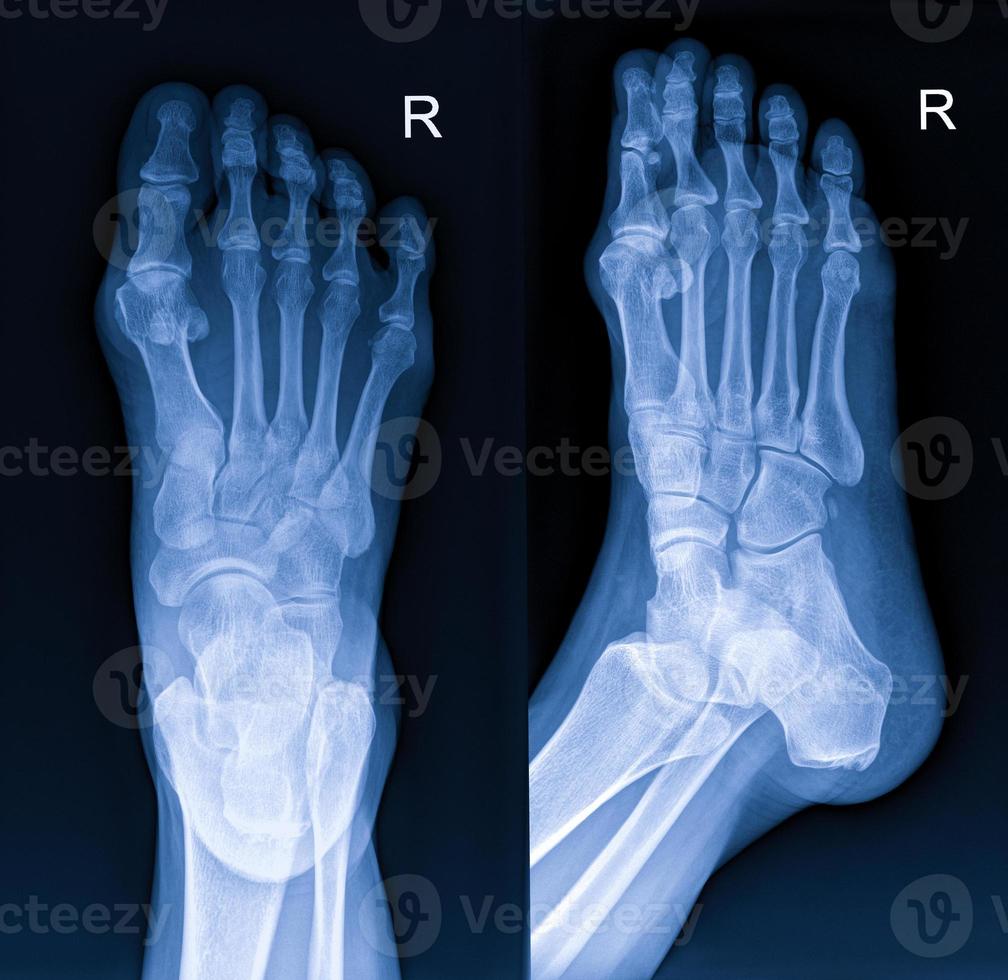 radiografía del pie foto