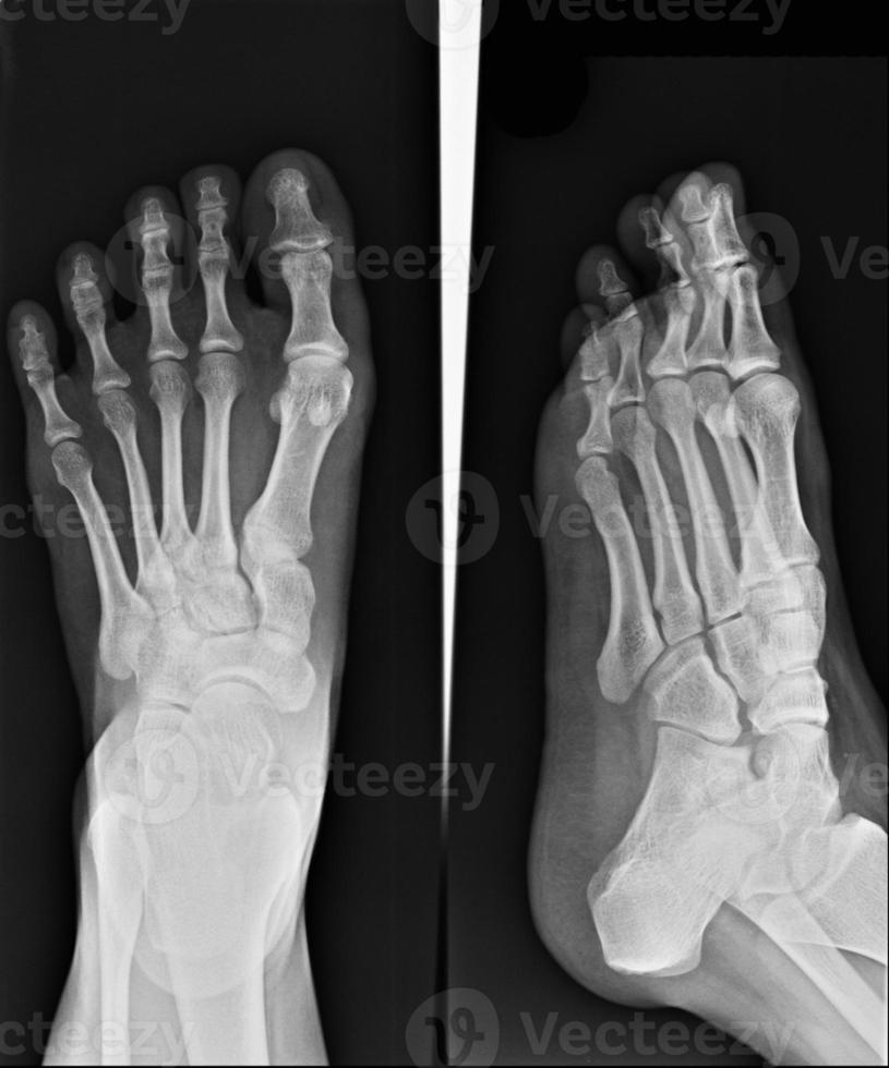 x-ray of foot photo