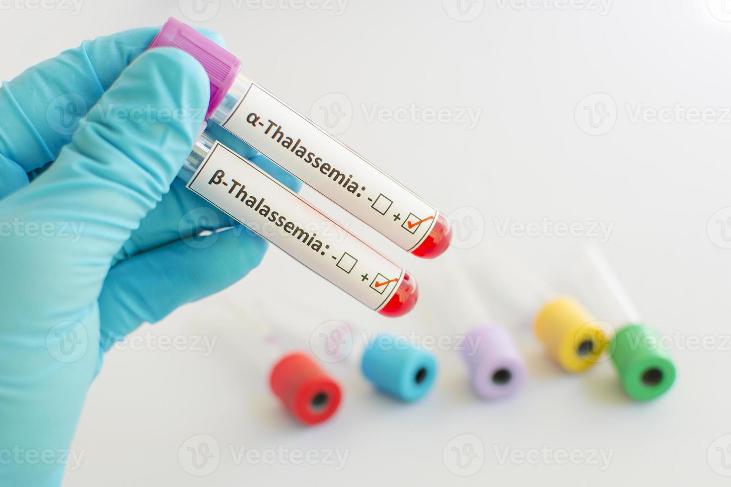 Beta and alpha thalassemia blood sample photo