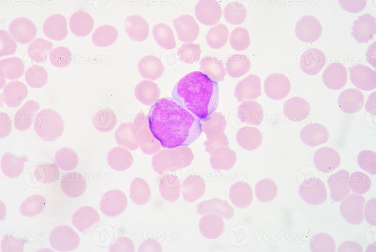 myeloblast