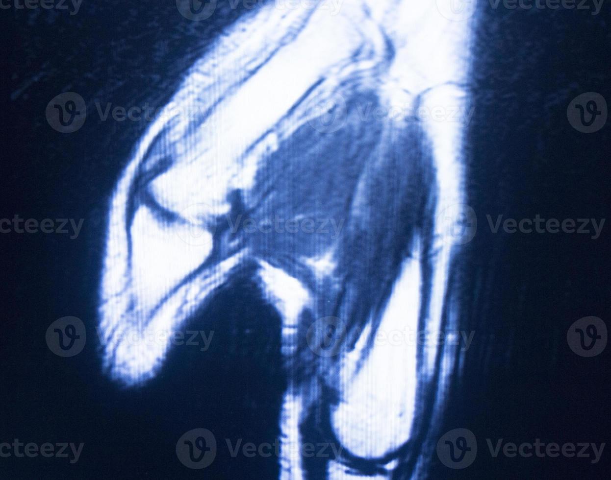 MRI magnetic resonance imaging hand carpal scan photo