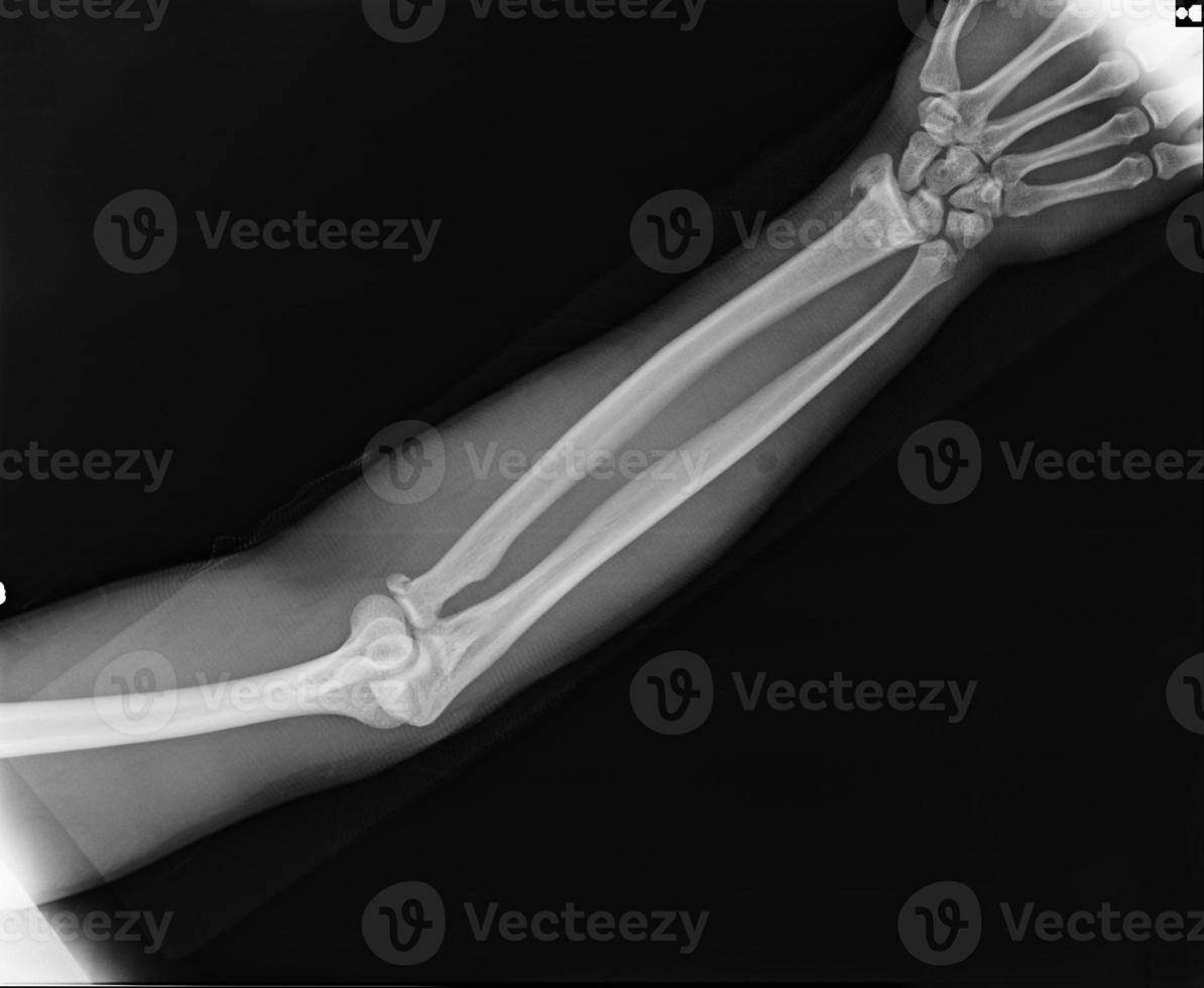 X-ray view of elbow photo