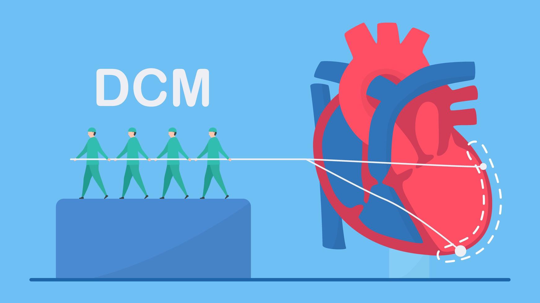 concepto de miocardiopatía dilatada con ventrículo izquierdo agrandado vector