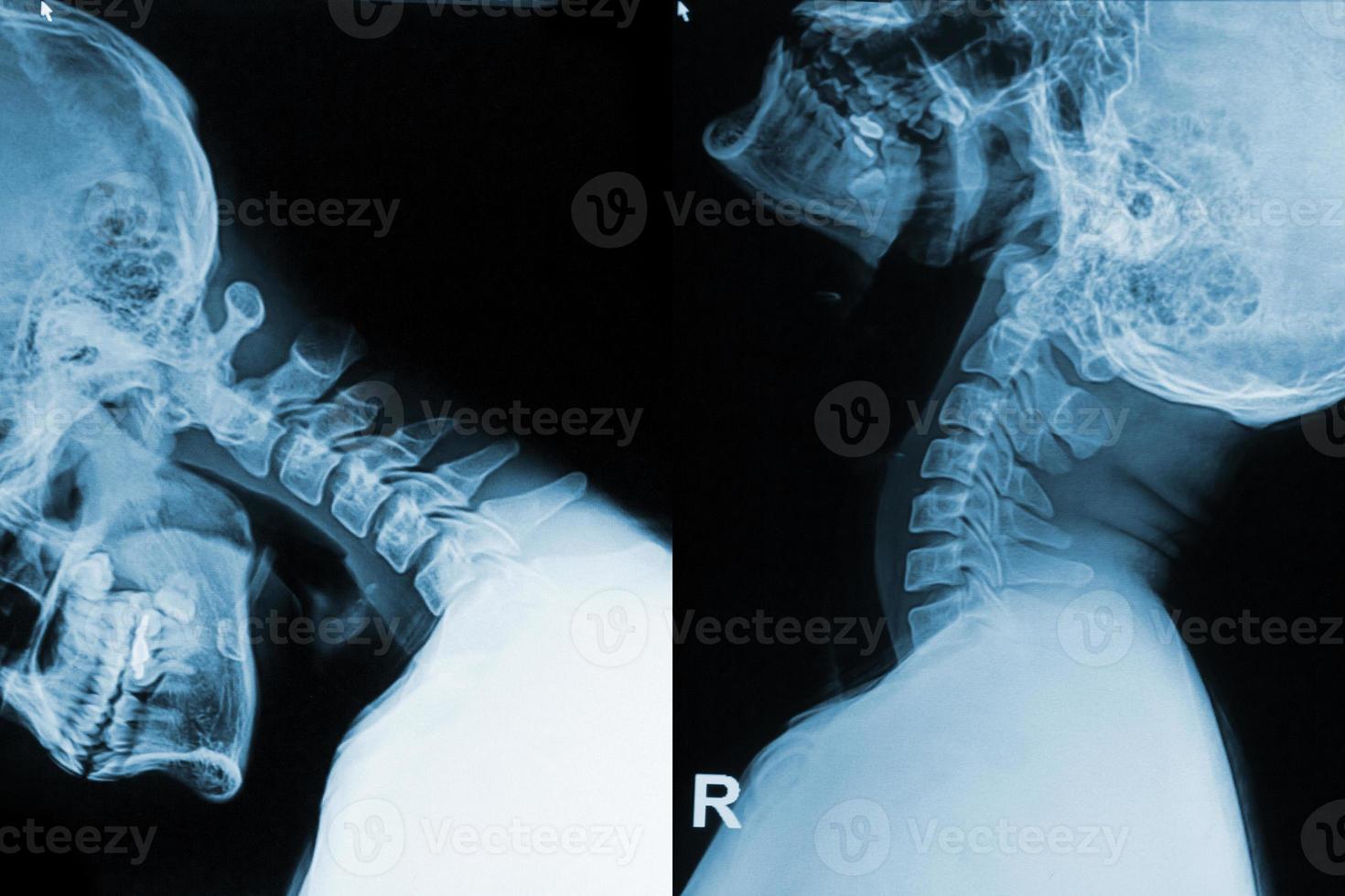 imagen de rayos X del dolor de cuello foto