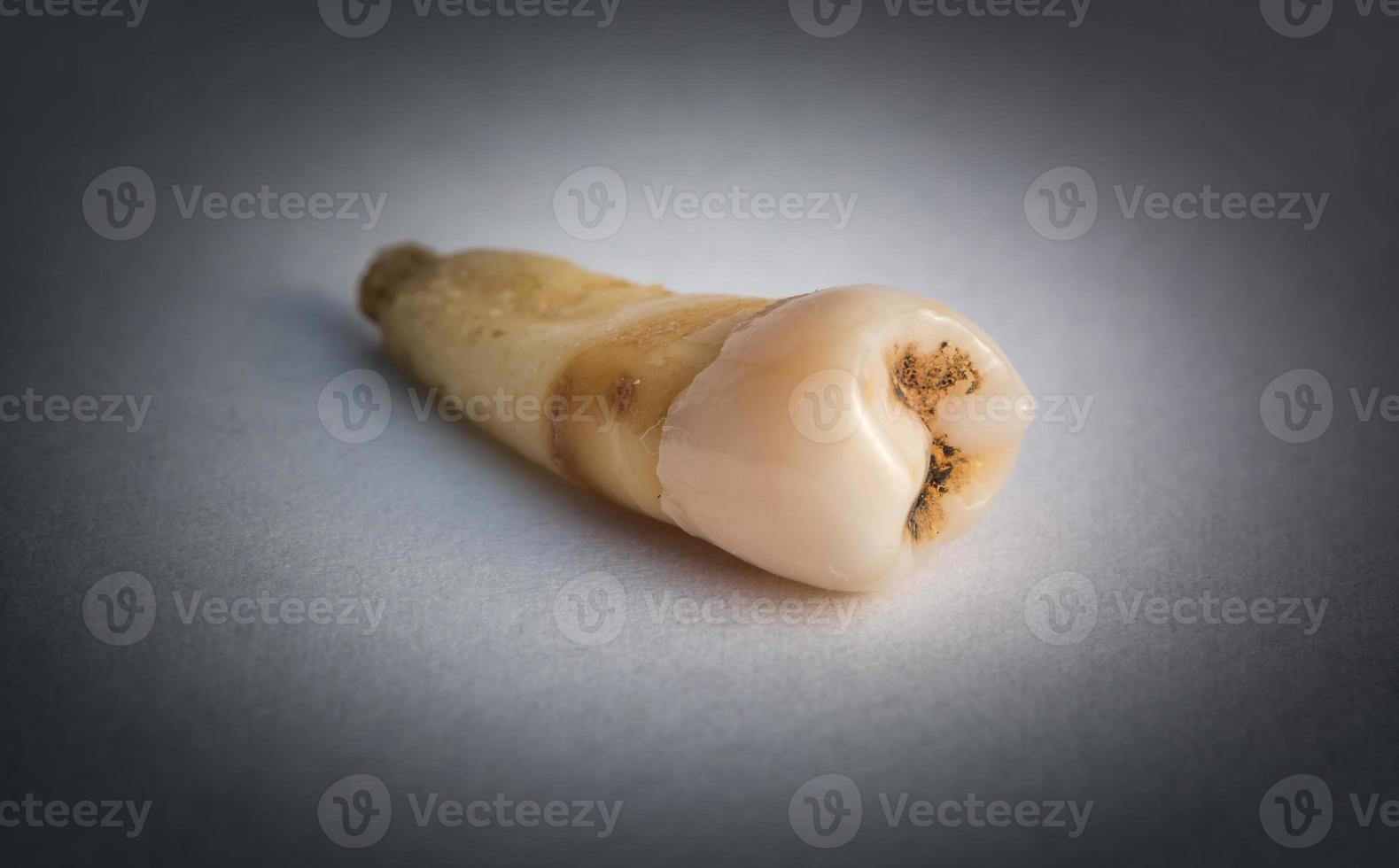 diente cariado foto