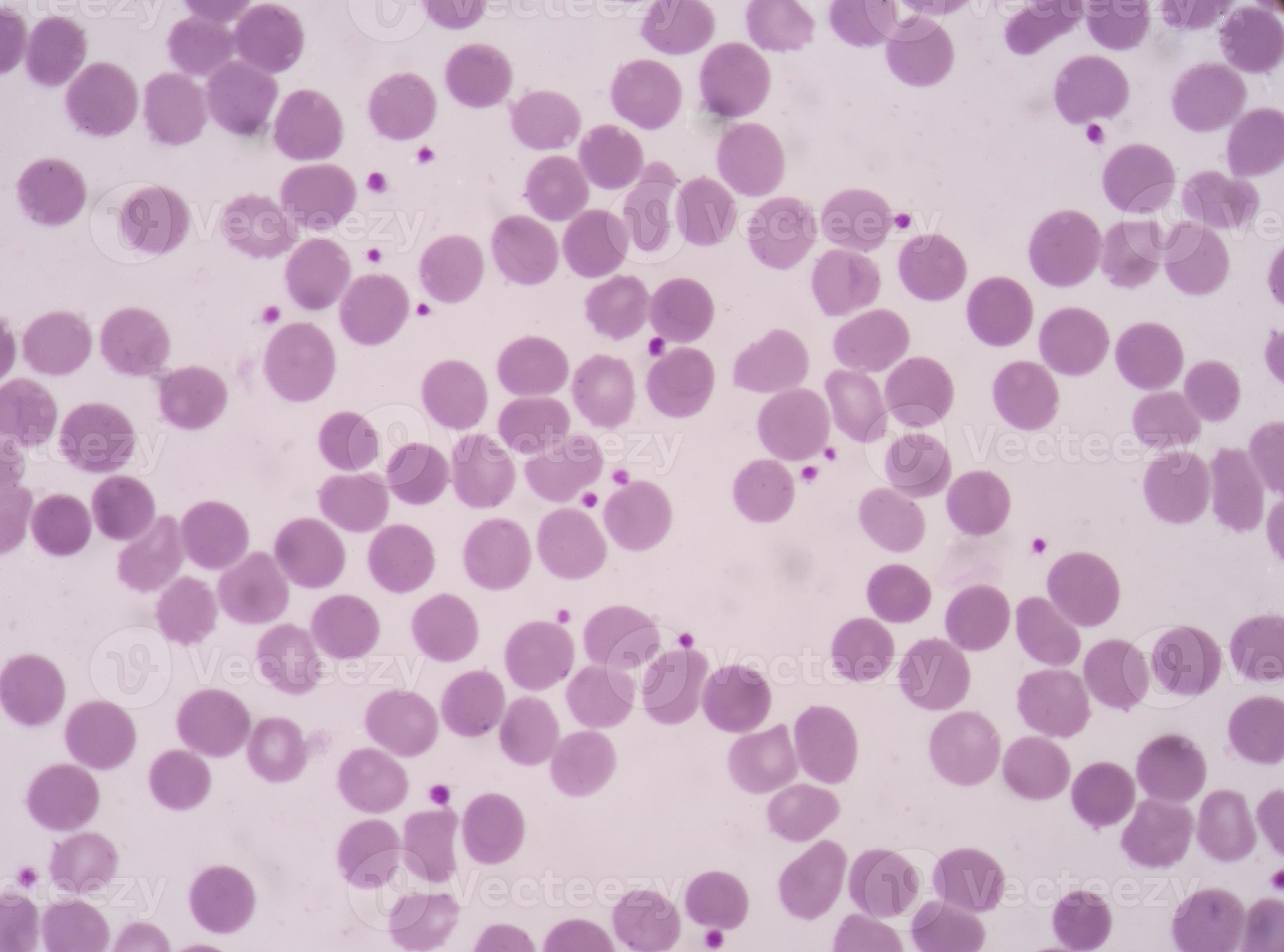 adequate platelet count in blood smear in hospital patients. 1083760