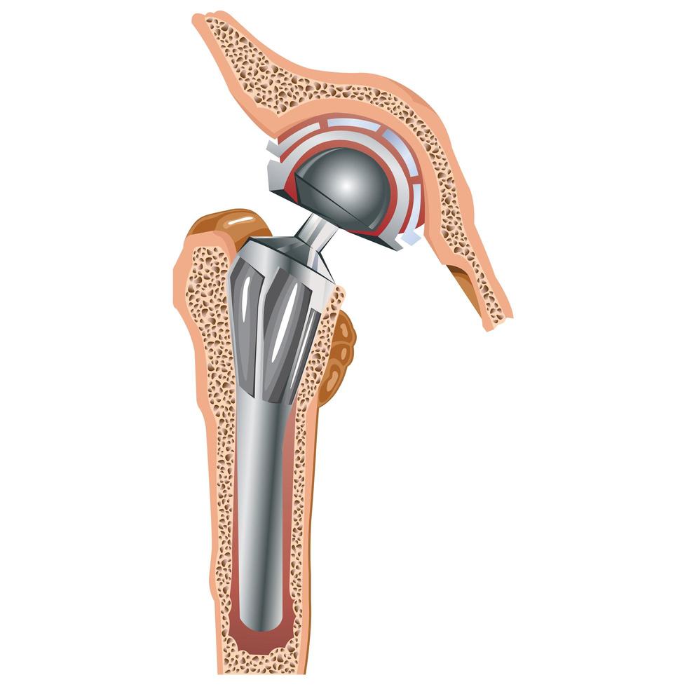 dibujo de artroplastia no cementada vector