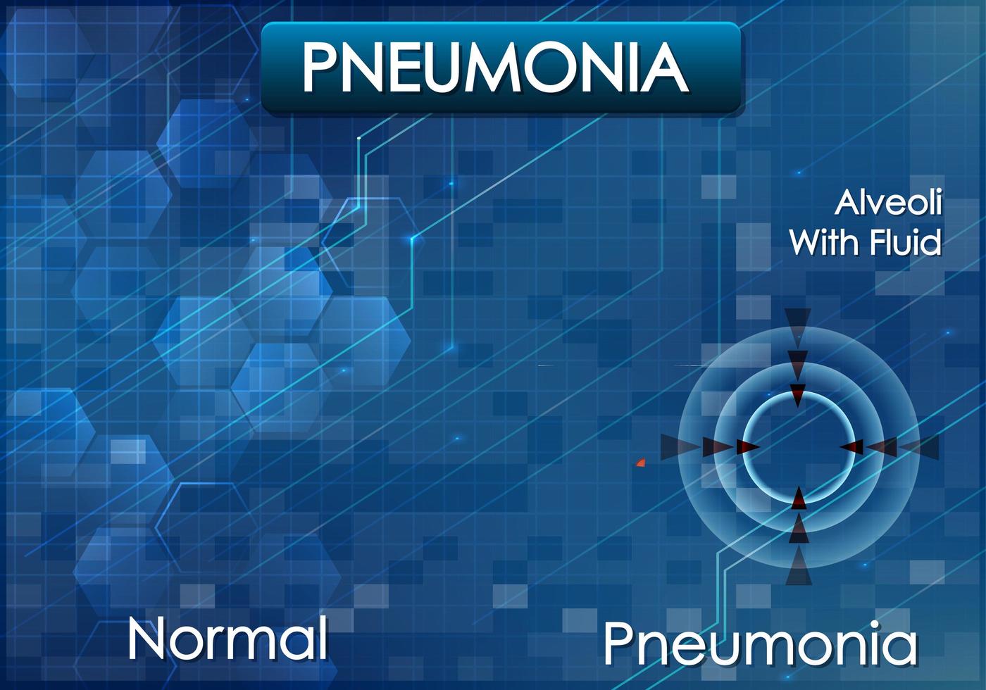 Poster design for pneumonia on blue background vector