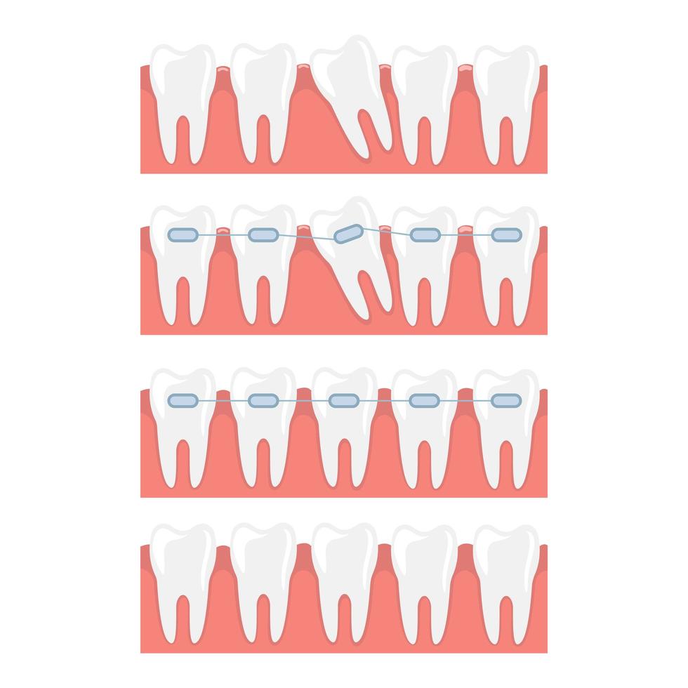 Braces isolated on white background vector
